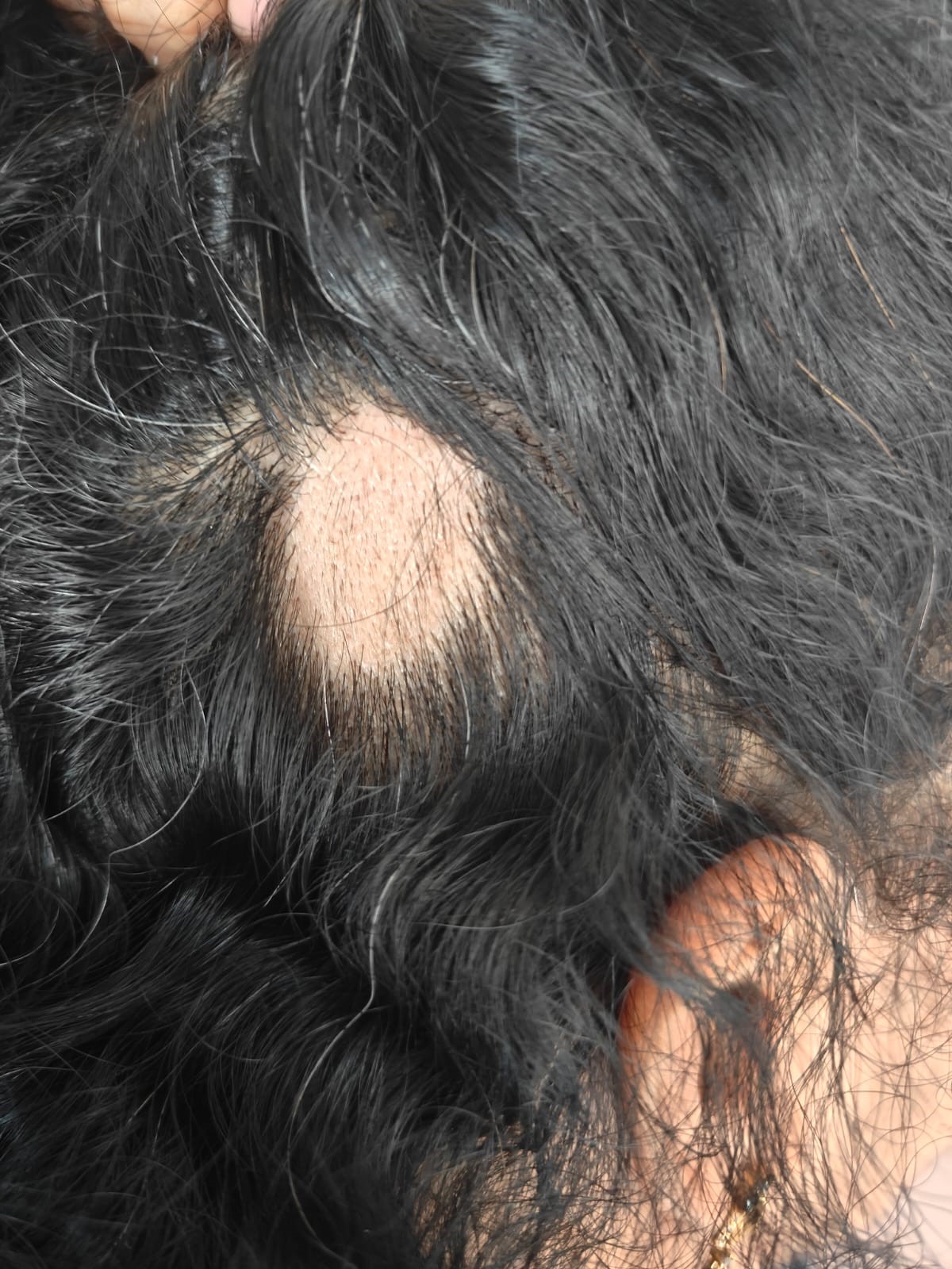 Alopecia Areata Treatment